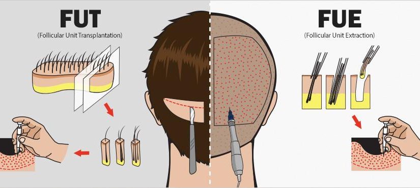 Transplantacija kose sa ekstrakcijom folikularne jedinice (FUE)